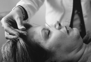 acupuncture du visage d'une femme